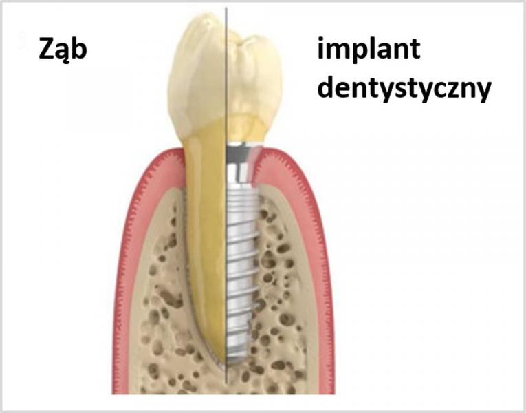 schemat-implantu